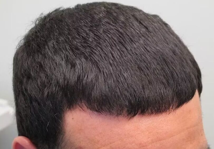 Am vindecat căderea părului Verdoxidil