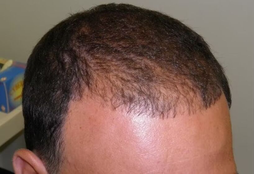 căderea părului înainte de a utiliza Verdoxidil